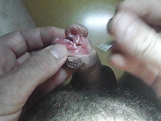 Sharp-witted together with subincision